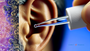 Rubbing Alcohol in Ear: Effective Remedy or Risky Move?